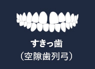 すきっ歯（空隙歯列弓）